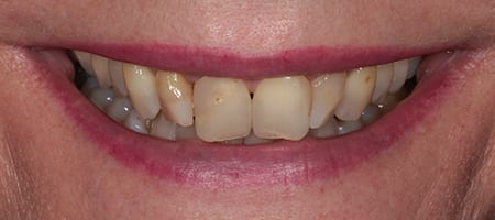 Before & after cosmetic bonding