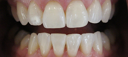 After Invisalign Treatment Smile Rooms Glasgow