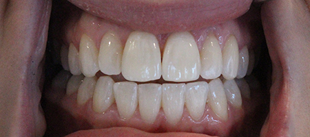 After Invisalign Treatment Smile Rooms Glasgow