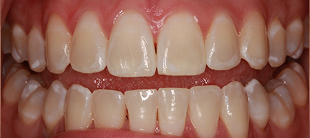 After Invisalign Treatment Smile Rooms Glasgow
