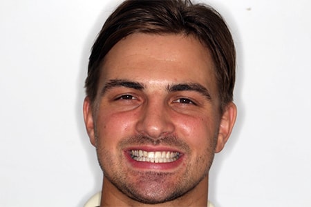 After Invisalign Treatment Smile Rooms Glasgow