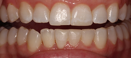 After Invisalign Treatment Smile Rooms Glasgow