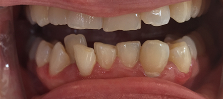 Before Invisalign Treatment Smile Rooms Glasgow