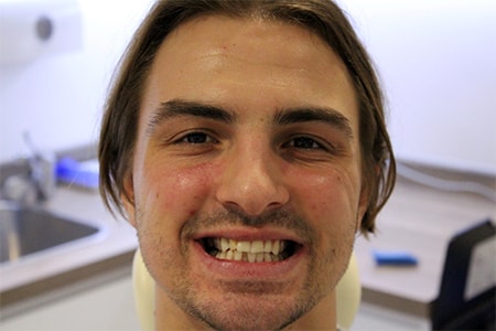 Before Invisalign Treatment Smile Rooms Glasgow