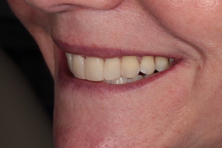 After Smile Makeover Treatment Reading Smiles
