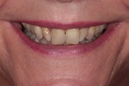 Before Smile Makeover Treatment Reading Smiles