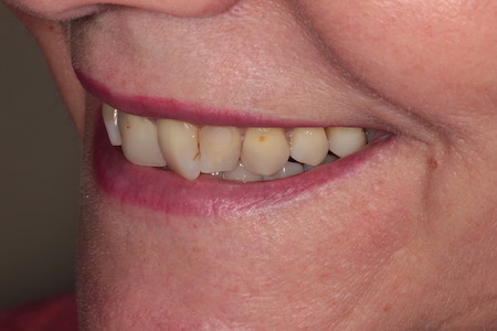 Before Smile Makeover Treatment Reading Smiles
