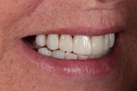 After Smile Makeover Treatment Reading Smiles