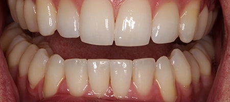 After Invisalign Treatment Smile Rooms Glasgow