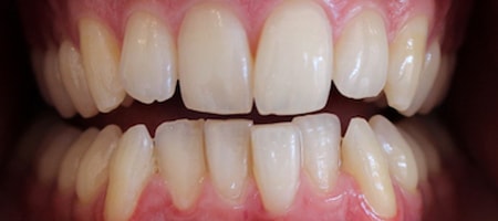 Before Invisalign Treatment Smile Rooms Glasgow