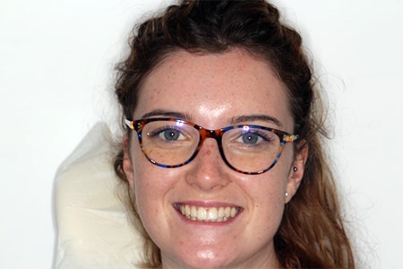 After Invisalign Treatment Smile Rooms Glasgow