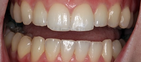 After Invisalign Treatment Smile Rooms Glasgow