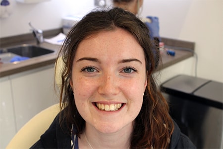 Before Invisalign Treatment Smile Rooms Glasgow