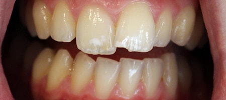Before Invisalign Treatment Smile Rooms Glasgow