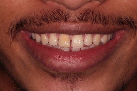 Before Smile Makeover Treatment Reading Smiles