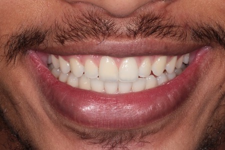 After Smile Makeover Treatment Reading Smiles