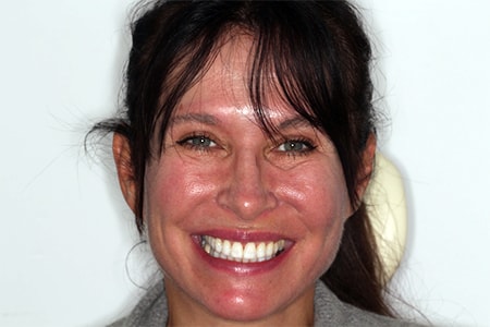 After Invisalign Treatment Smile Rooms Glasgow