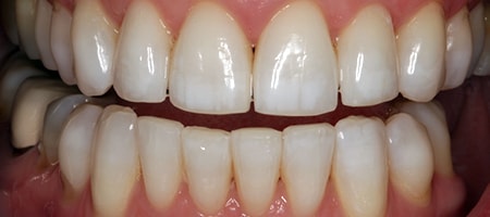 After Invisalign Treatment Smile Rooms Glasgow