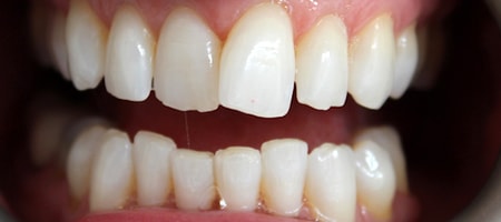 Before Invisalign Treatment Smile Rooms Glasgow