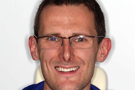 After Invisalign Treatment Smile Rooms Glasgow