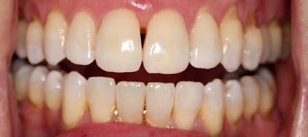 After Invisalign Treatment Smile Rooms Glasgow