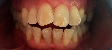 Before Invisalign Treatment Smile Rooms Glasgow