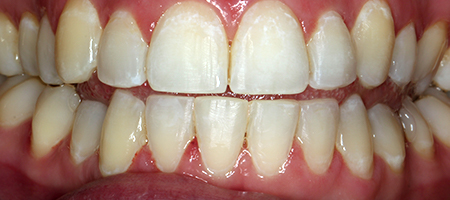 After Invisalign Treatment Smile Rooms Glasgow