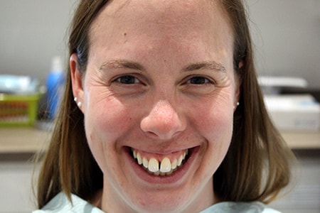 Before Invisalign Treatment Smile Rooms Glasgow