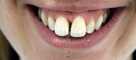 Before Invisalign Treatment Smile Rooms Glasgow