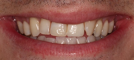 After Smile Makeover Treatment Reading Smiles