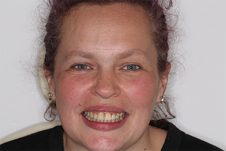 After Invisalign Treatment Smile Rooms Glasgow
