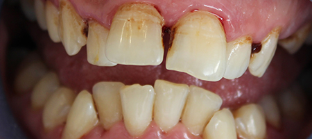 Before Invisalign Treatment Smile Rooms Glasgow
