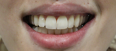 After Smile Makeover Treatment Reading Smiles