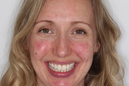 After Invisalign Treatment Smile Rooms Glasgow