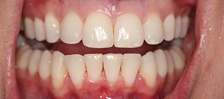 After Invisalign Treatment Smile Rooms Glasgow