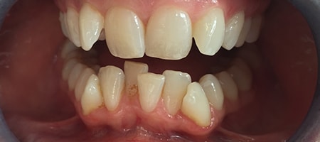 Before Invisalign Treatment Smile Rooms Glasgow
