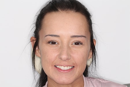 After Invisalign Treatment Smile Rooms Glasgow