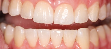 After Invisalign Treatment Smile Rooms Glasgow