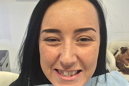 Before Invisalign Treatment Smile Rooms Glasgow