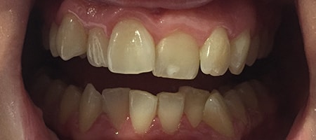 Before Invisalign Treatment Smile Rooms Glasgow