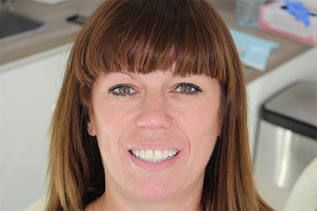 After Invisalign Treatment Smile Rooms Glasgow