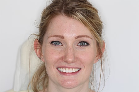 After Invisalign Treatment Smile Rooms Glasgow
