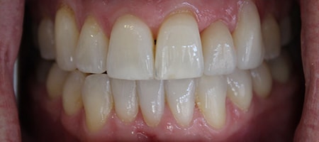 After Invisalign Treatment Smile Rooms Glasgow
