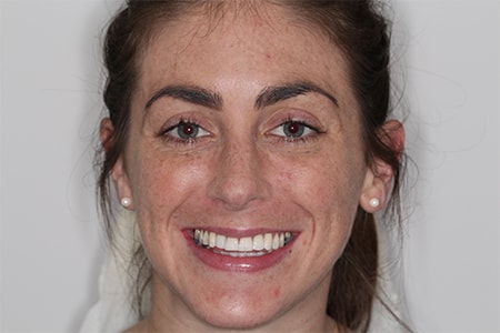 After Invisalign Treatment Smile Rooms Glasgow
