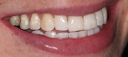 After Invisalign Treatment Smile Rooms Glasgow