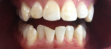 Before Invisalign Treatment Smile Rooms Glasgow