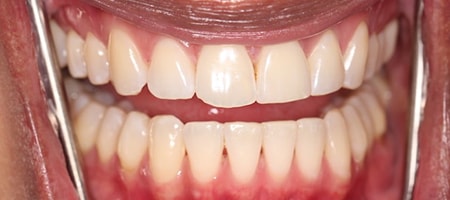 After Invisalign Treatment Smile Rooms Glasgow