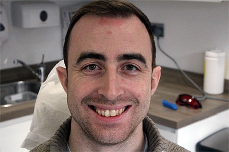 Before Invisalign Treatment Smile Rooms Glasgow