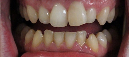 Before Invisalign Treatment Smile Rooms Glasgow