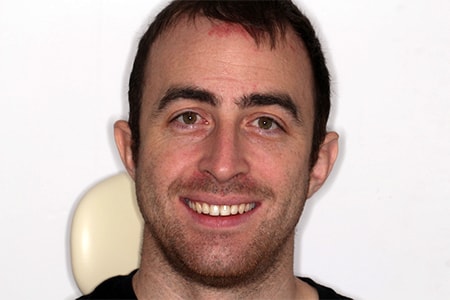 After Invisalign Treatment Smile Rooms Glasgow